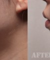 라인주사 4cc 1회