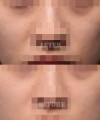 칙칙한 피부톤 개선 - 맥스지 1회