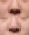 색소 5회 패키지 + 미백주사
