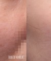 루비레이저 + 듀얼토닝