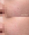 패인흉터 - 도트필링 1회